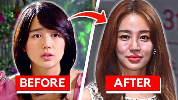Lim Ji-Yeon | Plastic Surgery Before And After